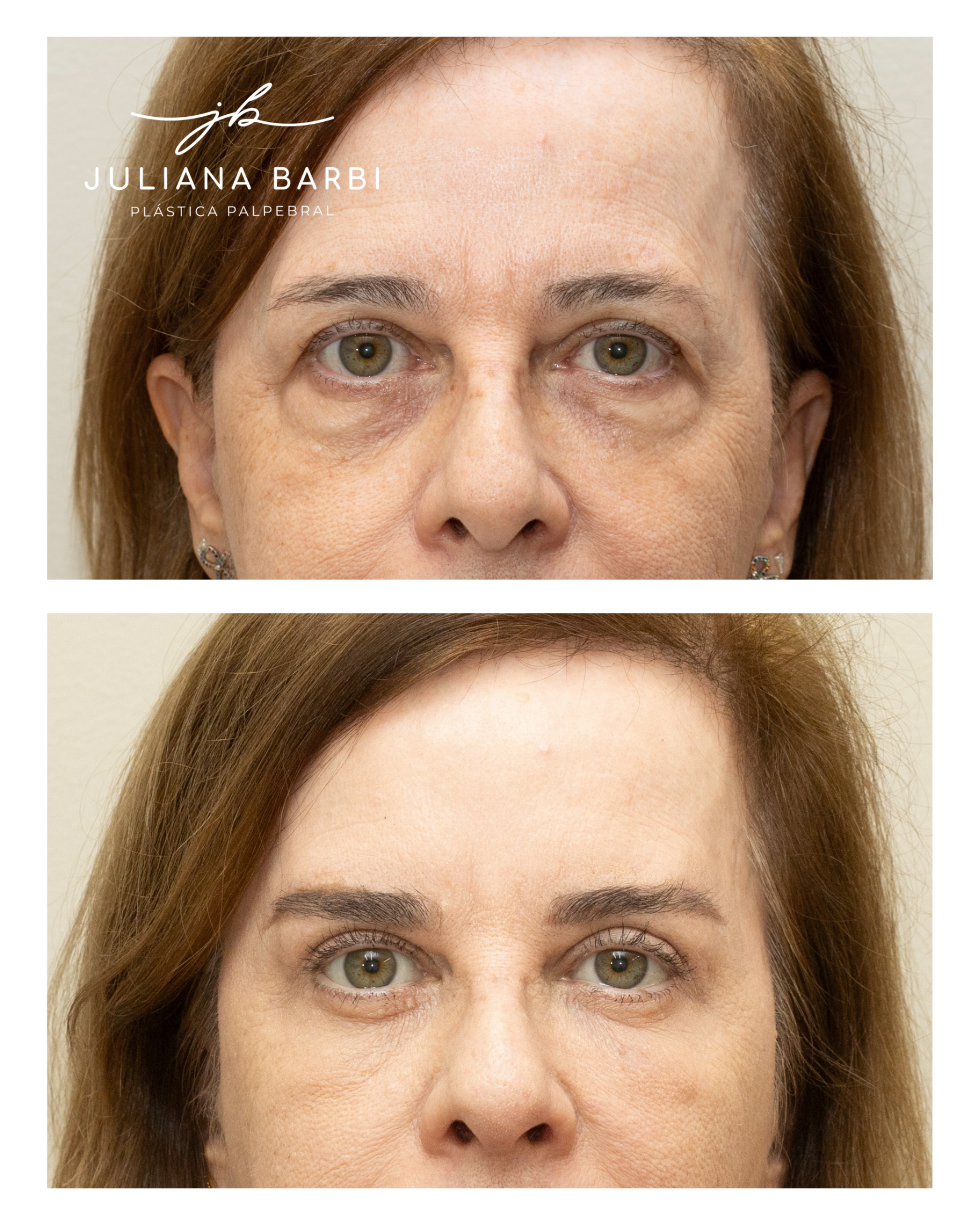 Caso 1, comparação antes e depois preservada