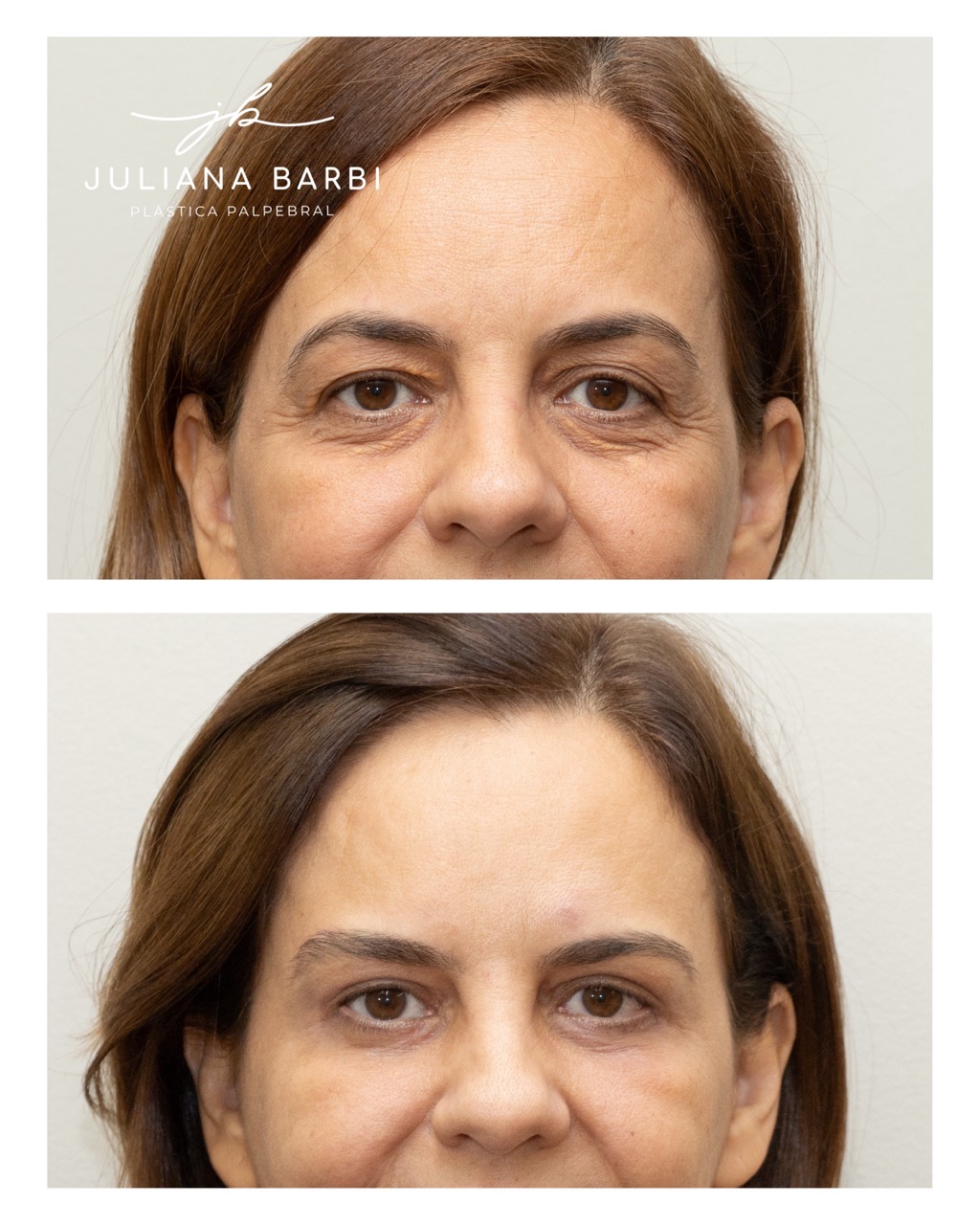 Caso 2, comparação antes e depois preservada
