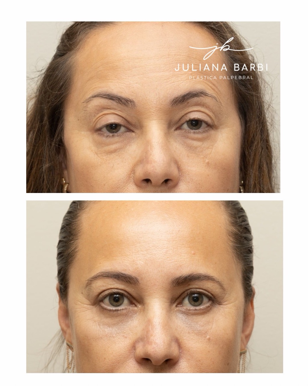 Caso 3, comparação antes e depois preservada