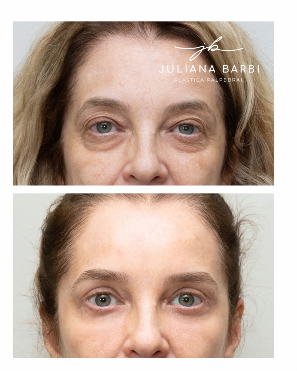 Caso 4, comparação antes e depois preservada