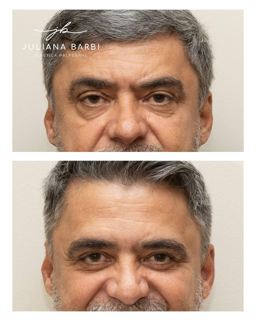 Caso 6, comparação antes e depois preservada